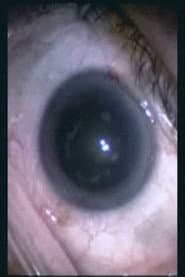 Botched Eyeball Operation